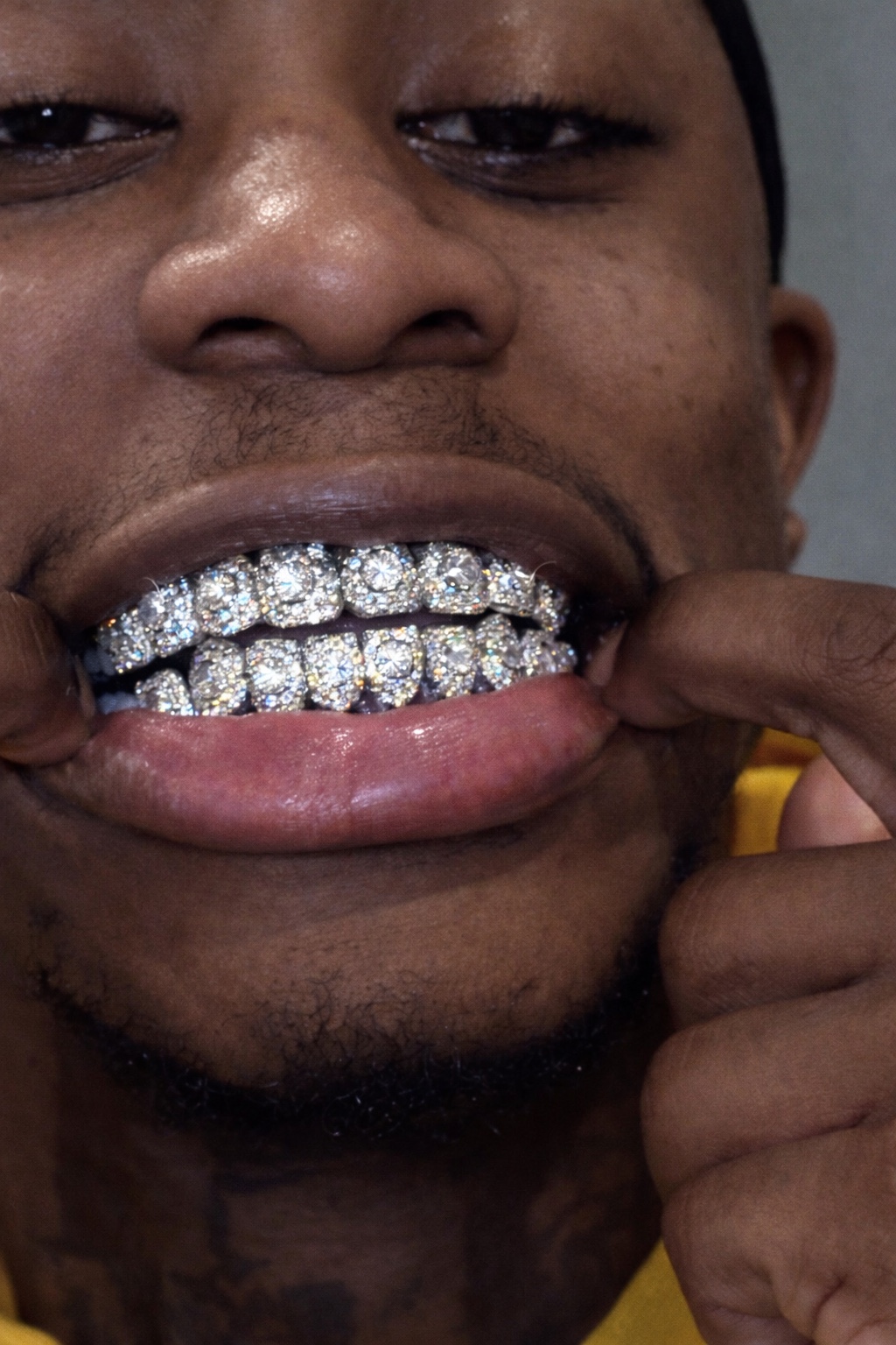 YZ Jewelers client wearing a fully iced custom top and bottom grillz set